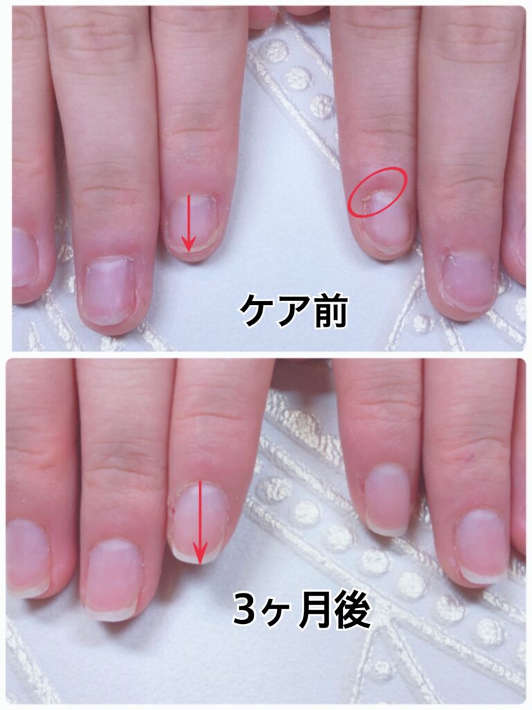 中学生／嚙み爪
